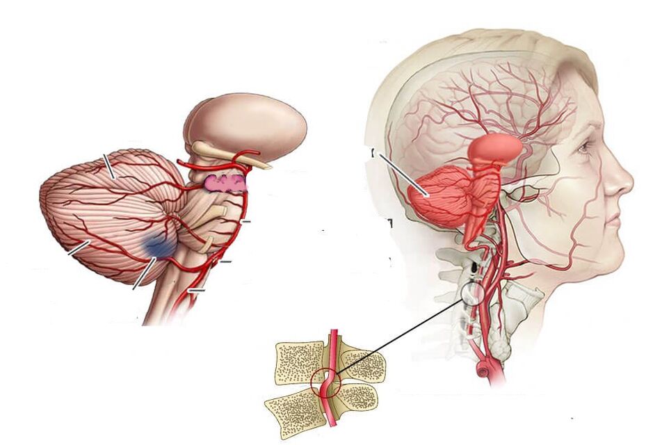 Isquemia cerebelosa